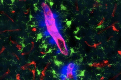 Amyloid beta protein deposits (blue) in the blood vessels (red) of a transgenic rat model